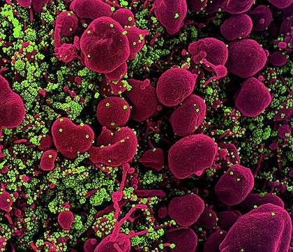 新型冠状病毒2019冠状病毒疾病株11`COVID-19, Novel Coronavirus SARS-CoV-2, Image No.11 by National Institute of Allergy and Infectious Diseases