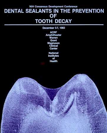 预防蛀牙的牙科密封剂`Dental sealants in the prevention of tooth decay (1983) by National Institutes of Health